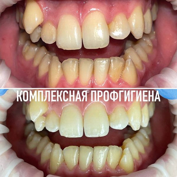 Профессиональная гигиена — пример работы №3, стоматология «Доктор Потанова», Симферополь