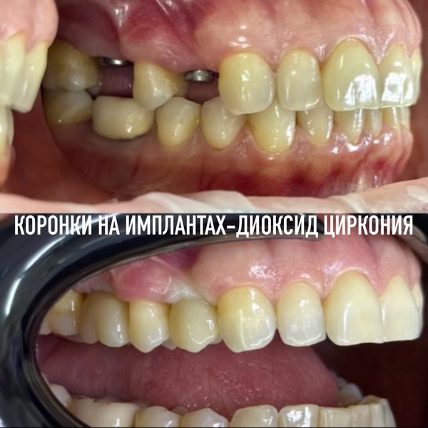 Имплантация зубов — пример работы №2, стоматология «Доктор Потанова», Симферополь