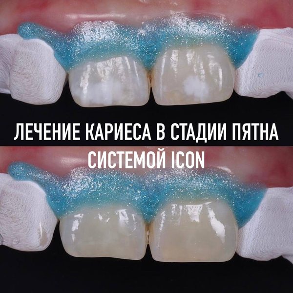 Лечение кариеса и реставрация — пример работы №4, стоматология «Доктор Потанова», Симферополь