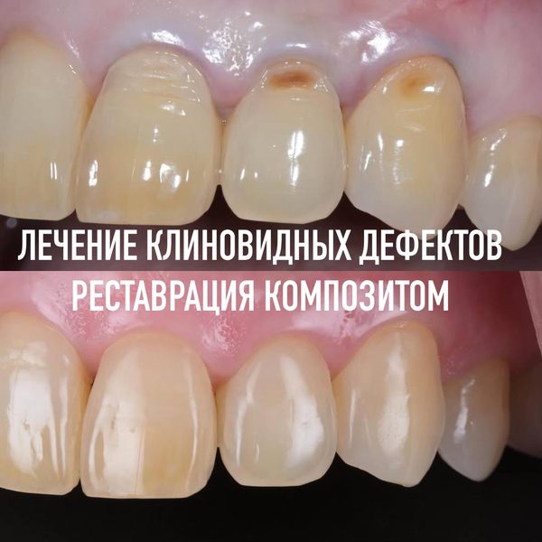 Лечение кариеса и реставрация — пример работы №5, стоматология «Доктор Потанова», Симферополь