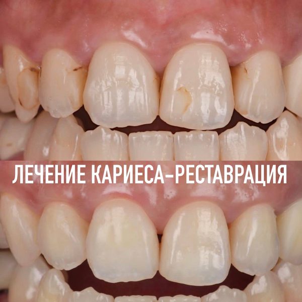 Лечение кариеса и реставрация — пример работы №6, стоматология «Доктор Потанова», Симферополь