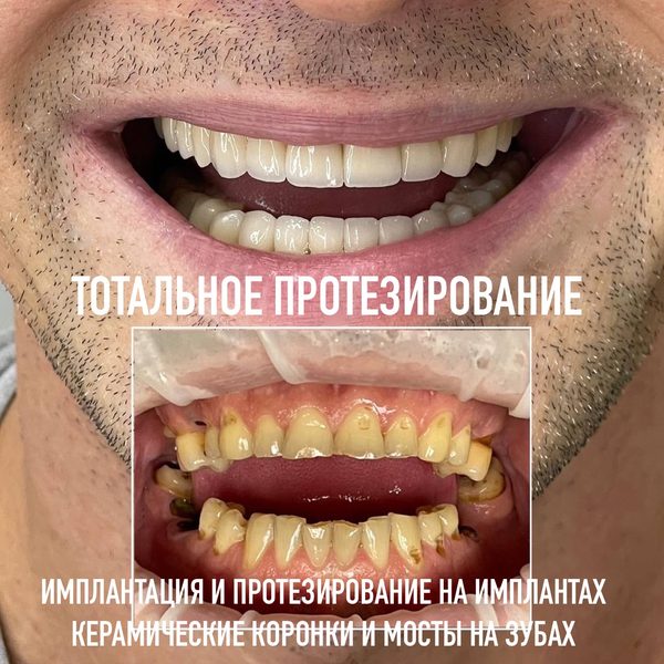 Коронки — пример работы №3, стоматология «Доктор Потанова», Симферополь