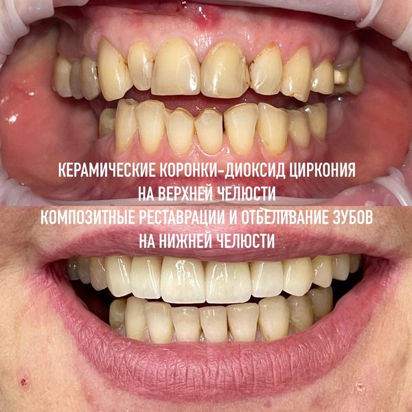 Коронки — пример работы №4, стоматология «Доктор Потанова», Симферополь
