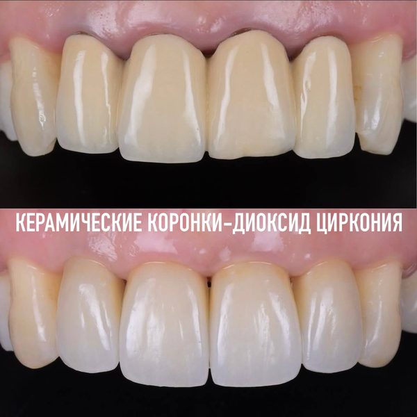 Коронки — пример работы №5, стоматология «Доктор Потанова», Симферополь