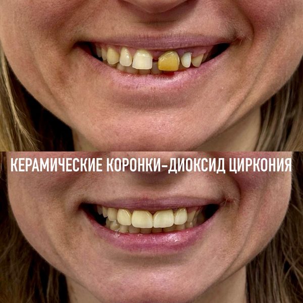 Коронки — пример работы №6, стоматология «Доктор Потанова», Симферополь