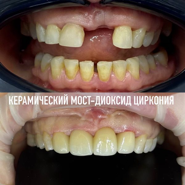 Коронки — пример работы №8, стоматология «Доктор Потанова», Симферополь