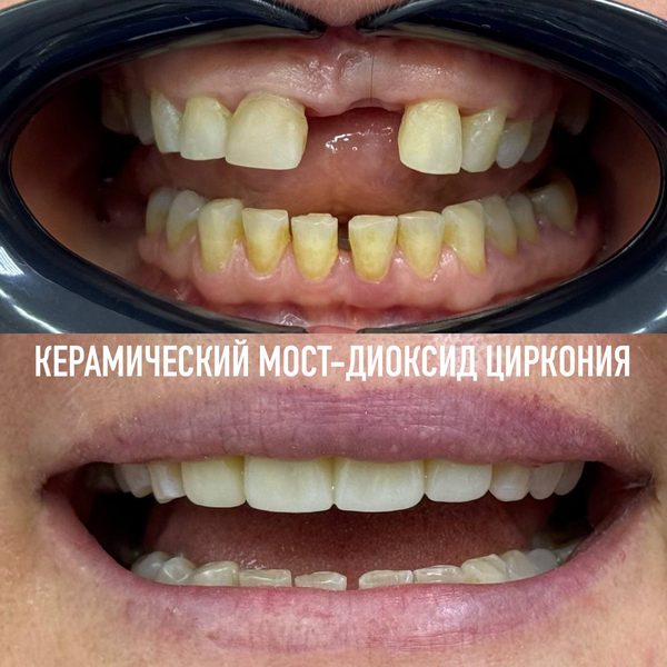 Коронки — пример работы №9, стоматология «Доктор Потанова», Симферополь