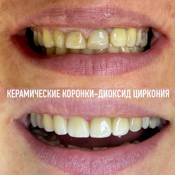 Коронки — пример работы №10, стоматология «Доктор Потанова», Симферополь