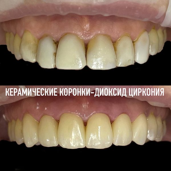 Коронки — пример работы №11, стоматология «Доктор Потанова», Симферополь