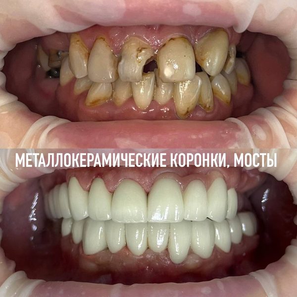 Коронки — пример работы №12, стоматология «Доктор Потанова», Симферополь