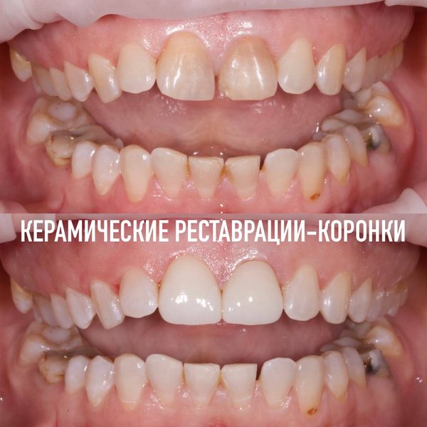 Коронки — пример работы №13, стоматология «Доктор Потанова», Симферополь