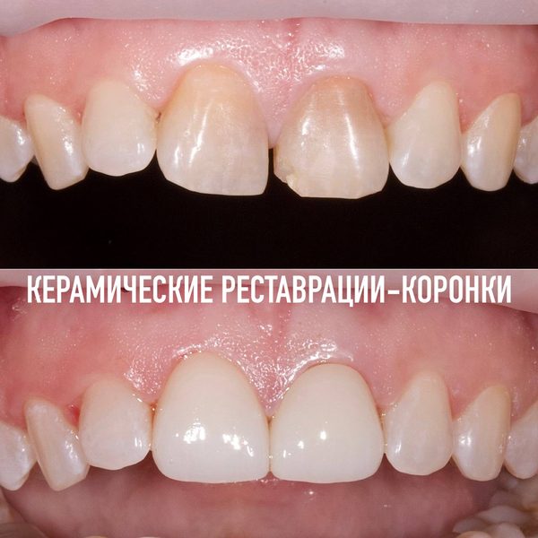 Коронки — пример работы №14, стоматология «Доктор Потанова», Симферополь