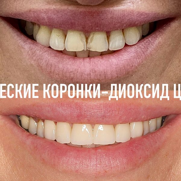 Коронки — пример работы №16, стоматология «Доктор Потанова», Симферополь