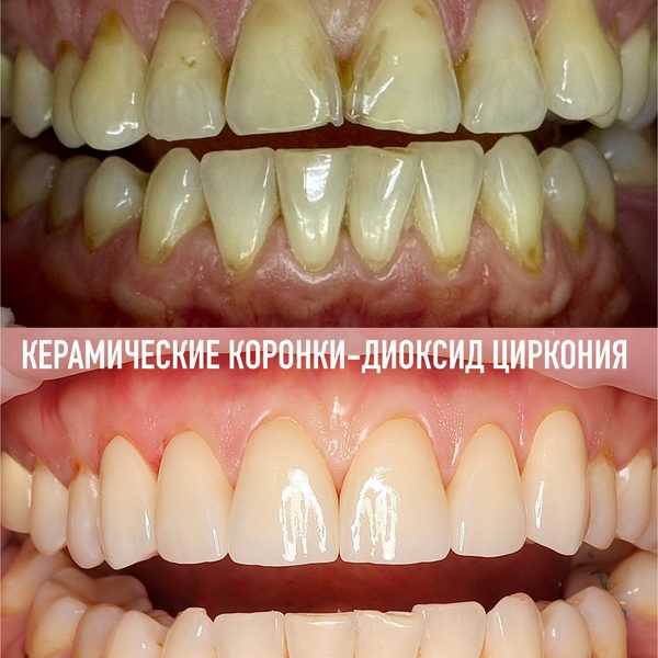 Коронки — пример работы №18, стоматология «Доктор Потанова», Симферополь