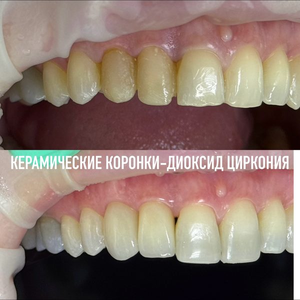 Коронки — пример работы №19, стоматология «Доктор Потанова», Симферополь