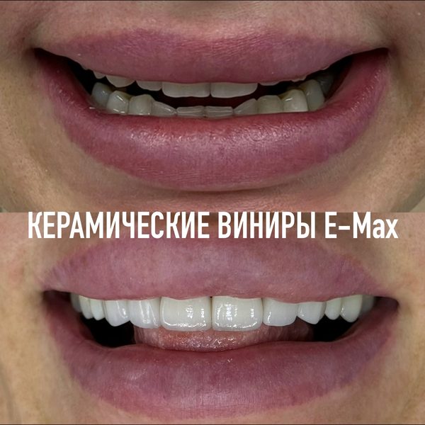 Виниры — пример работы №8, стоматология «Доктор Потанова», Симферополь