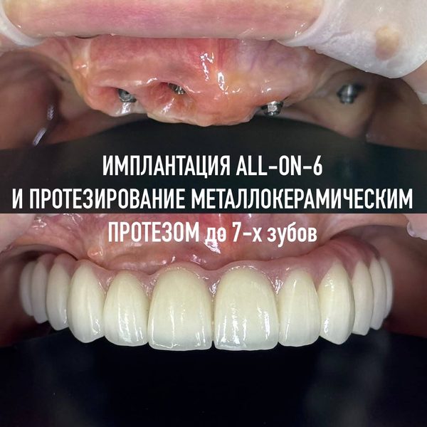 Имплантация All-on-4 / All-on-6 — пример работы №5, стоматология «Доктор Потанова», Симферополь